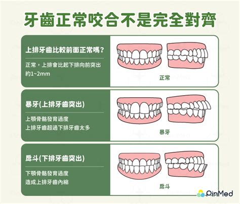 上排牙齒蓋住下排牙齒